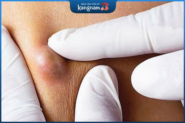 Phương pháp điều trị u nang bã đậu hiệu quả