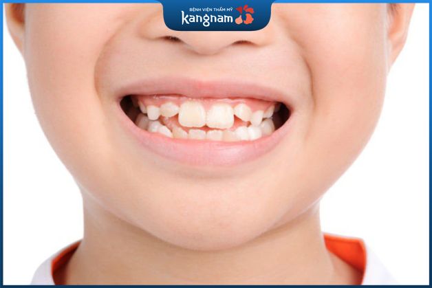 Về độ lệch của răng