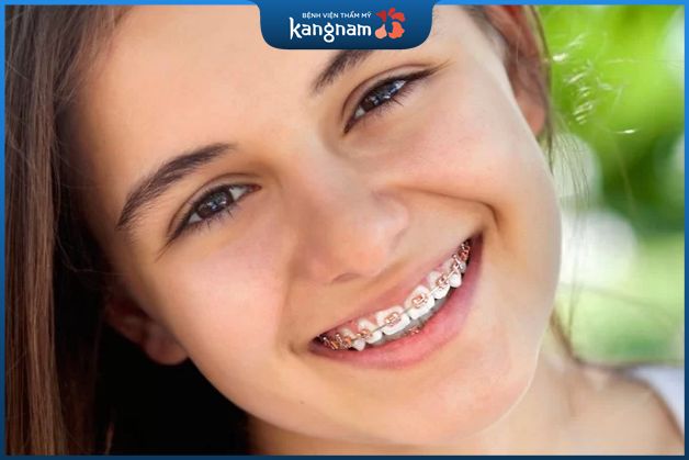 Niềng răng mắc cài sứ mất bao lâu