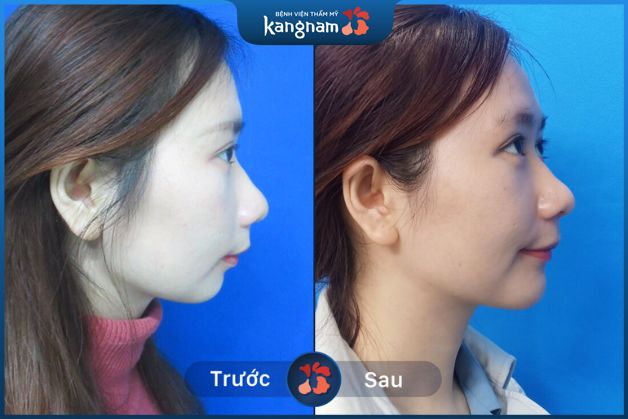 Độn cằm chỉnh hàm hô ngay sau 1 ca phẫu thuật, hồi phục nhanh chóng