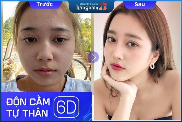 Đẹp tự nhiên với công nghệ độn cằm 6D