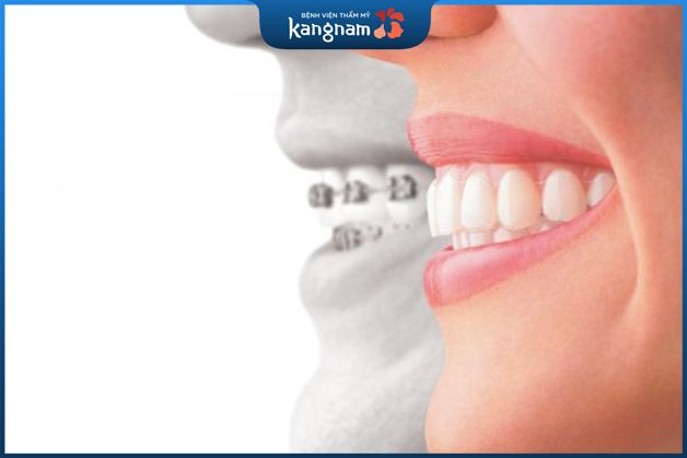 Kết thúc quá trình niềng răng