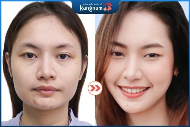 Sở hữu khuôn mặt chuẩn V line một cách dễ dàng