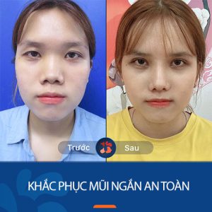 Cùng chuyên gia tìm hiểu về giải pháp khắc phục mũi ngắn an toàn