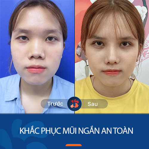 Cùng chuyên gia tìm hiểu về giải pháp khắc phục mũi ngắn an toàn