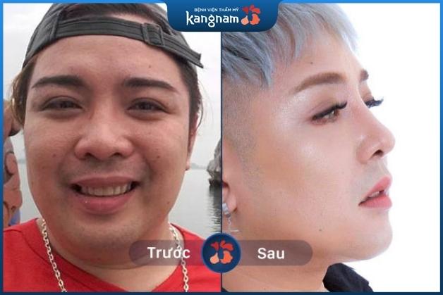 Một chiếc mũi đẹp cho nam giới phải đảm bảo các tiêu chí sống mũi cao, thẳng, không gồ lệch