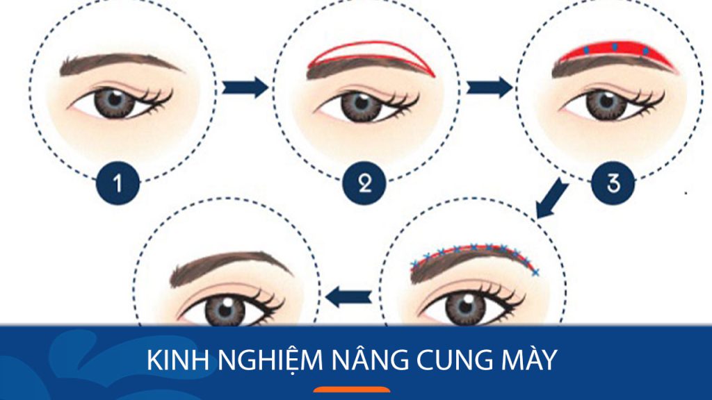 Nâng cung mày: Bí quyết trẻ hóa “thần tốc” cho đôi mắt và khuôn mặt