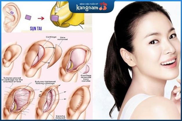 lấy sụn tai nâng mũi có đau không?