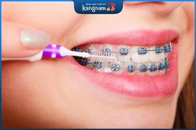 Những lưu ý về việc chăm sóc răng miệng khi niềng răng