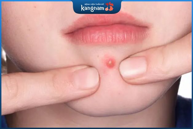 Những điều cần lưu ý khi trị mụn đầu đinh