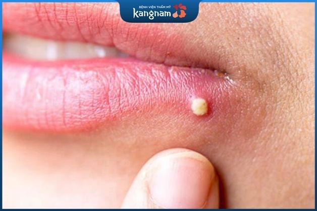 Lưu ý khi trị mụn đinh để ngừa rủi ro nguy hiểm