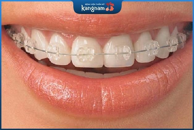 Mắc cài sứ không gây mất thẩm mỹ khi niềng răng