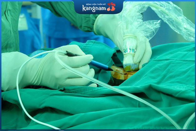 Quá trình mổ u nang tuyến