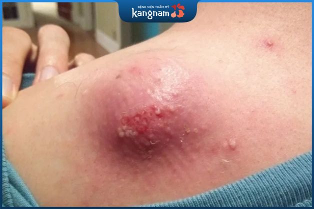 Mụn bã đậu có gây nguy hiểm không?