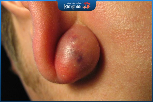 Mụn bã đậu còn có nhiều tên gọi khác là u nang tuyến bã hay u nang bã đậu