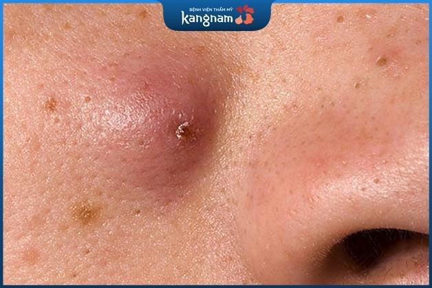 Mụn đầu đinh tiềm ẩn khá nhiều nguy hại