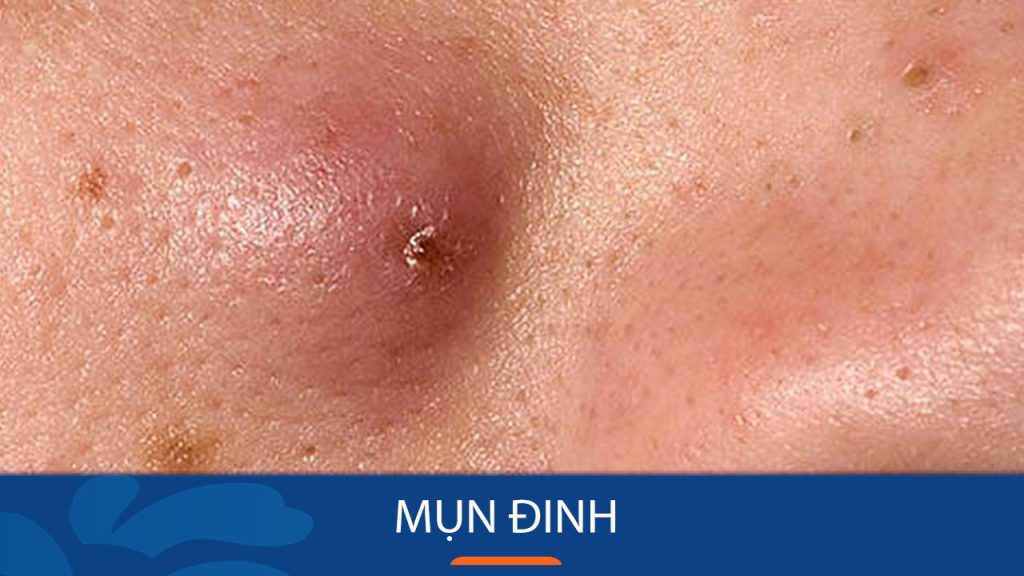 Mụn đinh là gì? Nguyên nhân và cách điều trị hiệu quả