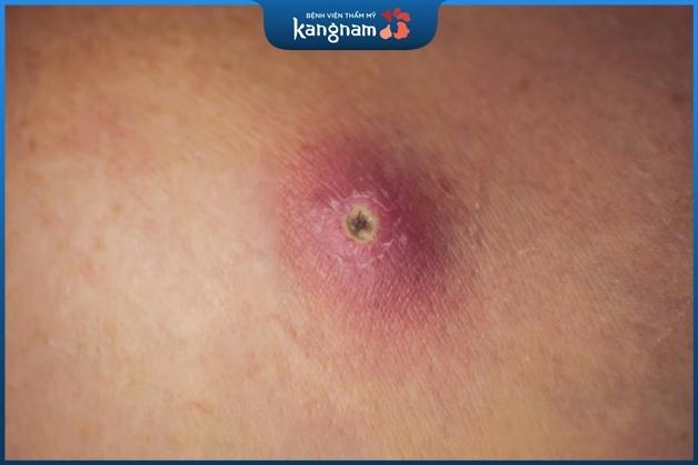 Mụn đinh có thể tự khỏi