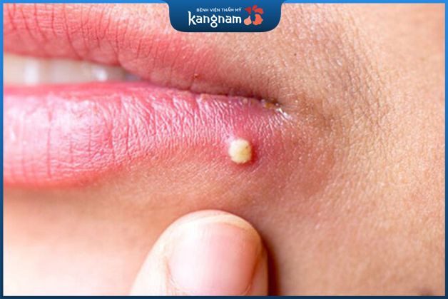 Mụn đinh râu là gì?