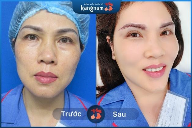 Nâng cung chân mày, trẻ hóa đôi mắt nhanh chóng tại Kangnam