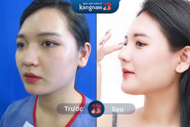 Gương mặt cân đối và hài hòa hơn