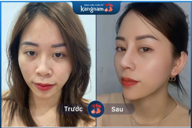 Cải thiện mũi lệch vẹo