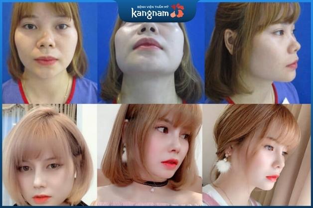 Khuôn mặt trở nên thanh thoát hơn sau khi thu nhỏ cánh mũi