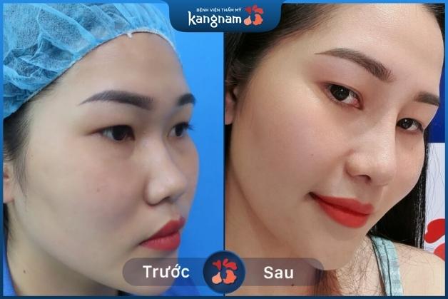 Mũi cô ấy không hề có dấu tích gì sau thu gọn cánh mũi
