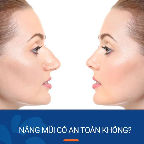 Nâng mũi có an toàn không? Khi nào an toàn và khi nào không