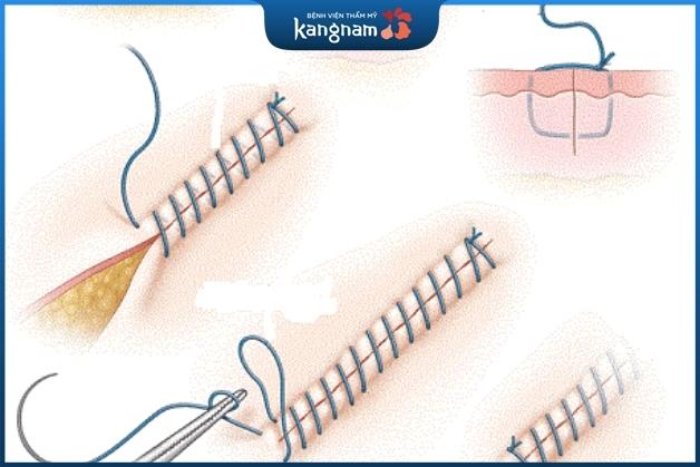 Chỉ thẩm mỹ mảnh, nhỏ, dễ dàng lành vết thương