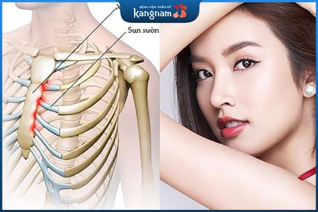 Nâng mũi bọc sụn uy tín 