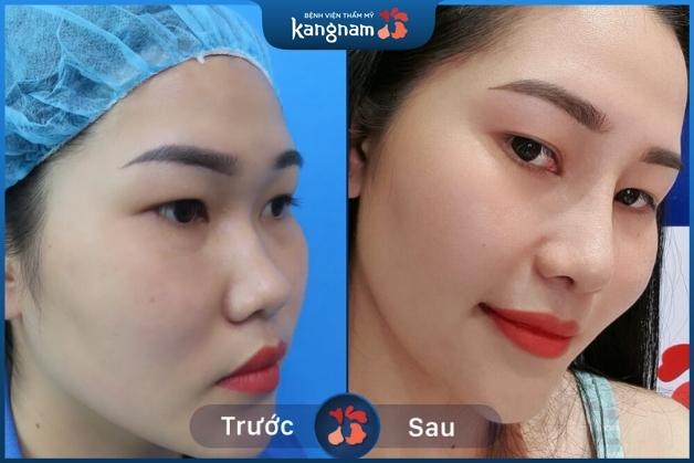Thẩm mỹ để thu gọn cánh mũi và thu nhỏ đầu mũi