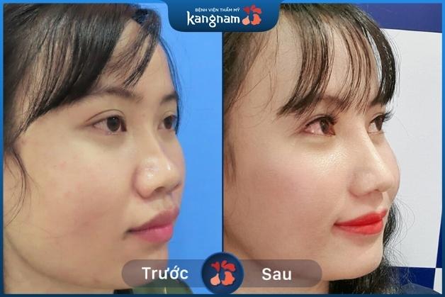 Khắc phục trường hợp cánh mũi to