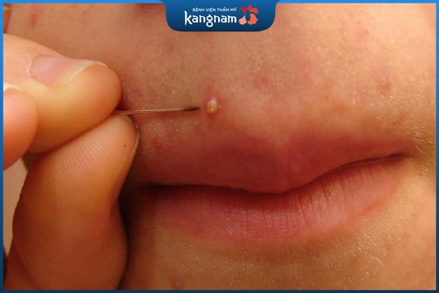 Nguyên nhân hình thành mụn đinh râu do đâu?