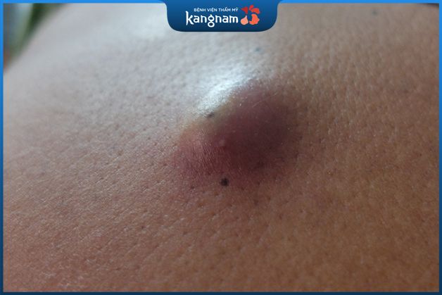 Nguyên nhân hình thành u bã đậu