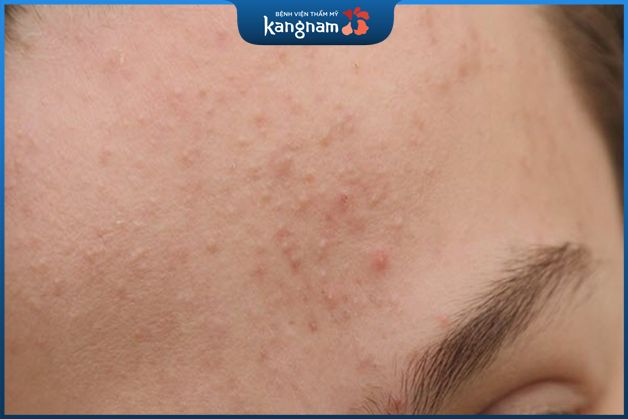 cách xông mặt trị mụn ẩn