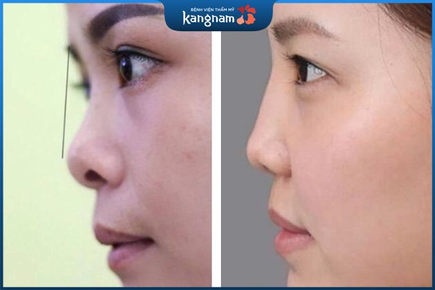 Nhược điểm khi nâng mũi bằng chỉ