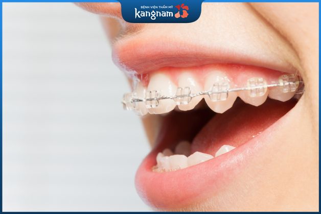 Niềng răng mắc cài sứ mất bao lâu?