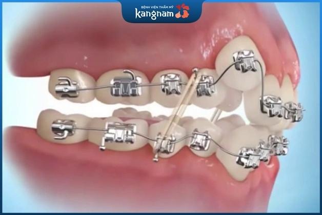 Niềng răng mắc cài kim loại