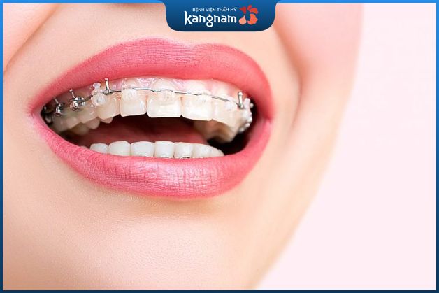 Niềng răng mắc cài sứ có độ bền cao hơn