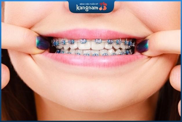 Niềng răng mắc cài kim loại không đau đớn nhiều như chúng ta thường nghĩ