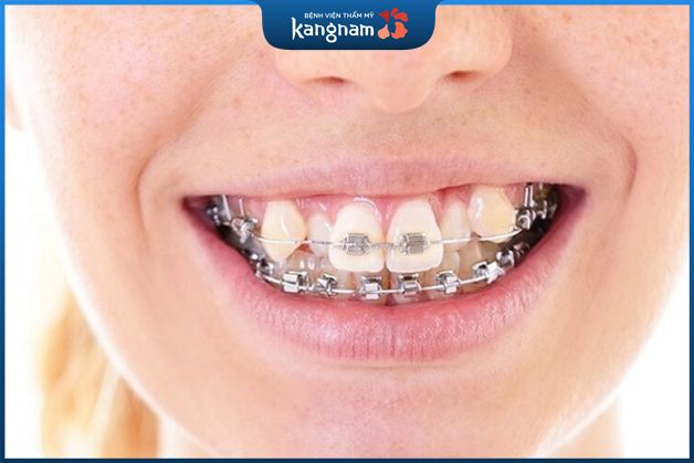 Niềng răng giữ lại răng khểnh được không?