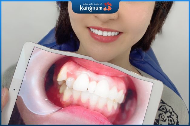 Thành quả khách hàng niềng răng thành công