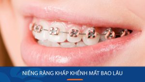 Niềng răng khấp khểnh mất bao lâu? 3 Yếu tố ảnh hưởng