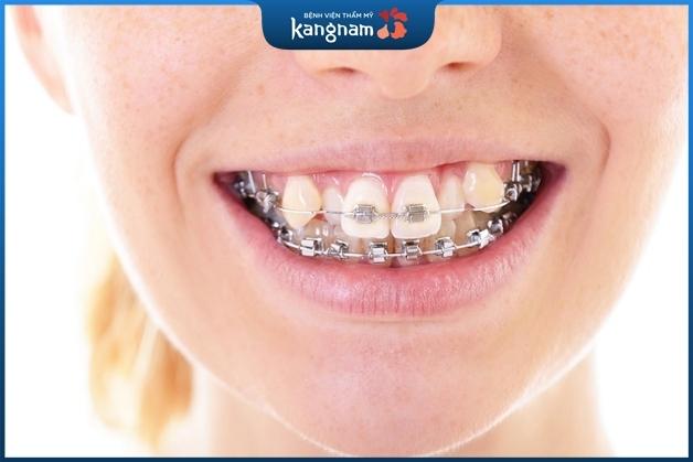 Niềng răng mắc cài kim loại có nhiều ưu điểm nổi bật