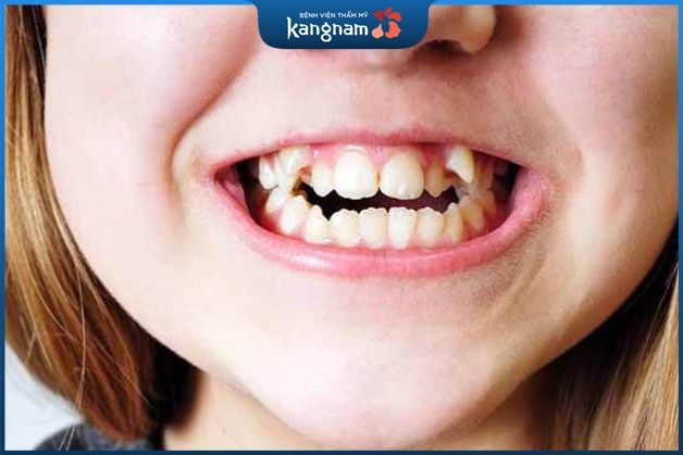 Niềng răng khểnh có phải nhổ răng không?