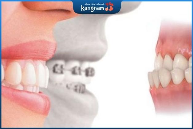 Niềng răng khớp cắn ngược bao lâu?
