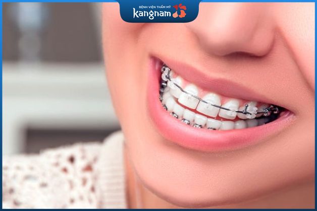 Niềng răng mắc cài kim loại tự động mất bao lâu?