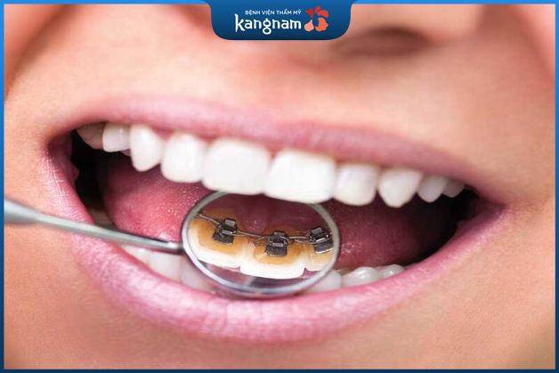 Niềng răng mắc cài kim loại mặt trong cũng mang đến hiệu quả cao