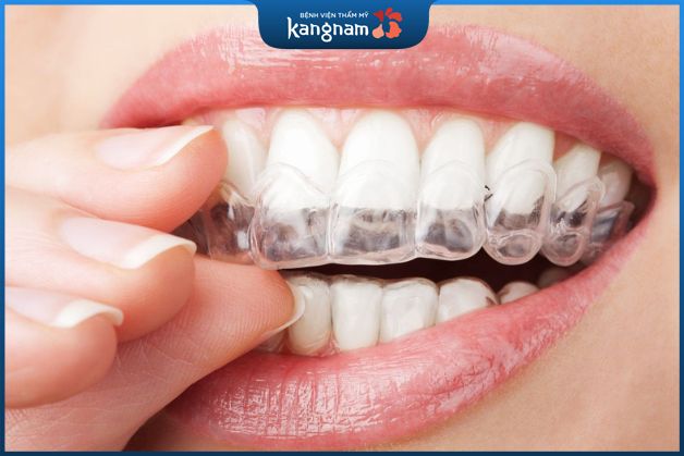 Niềng răng tự tháo lắp có tốt không - Invisalign